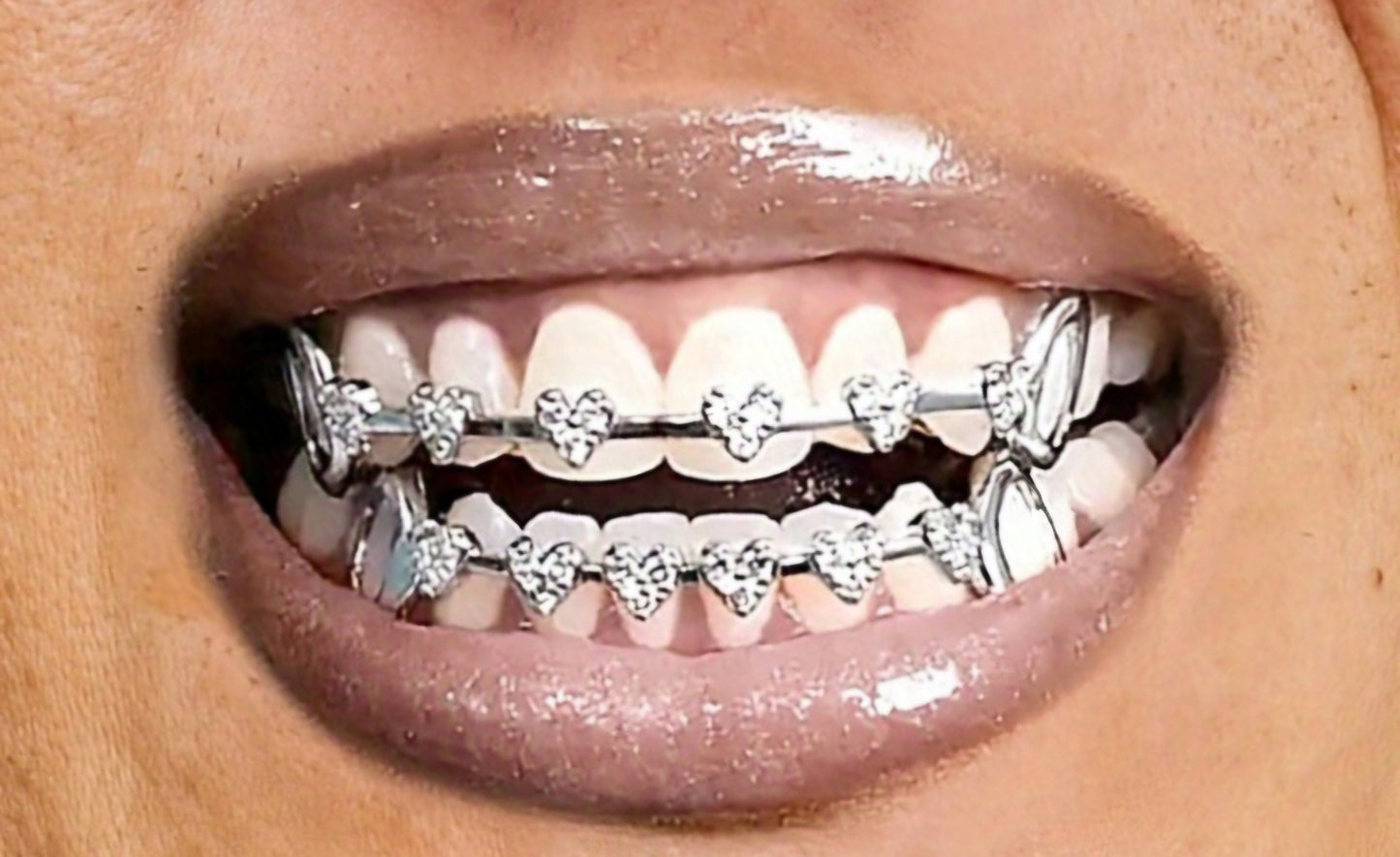 Heart Braces Design ( Priced For 8 Top 8 Bottom)